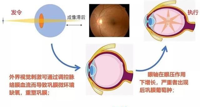 雾视疗法在近视防控中的作用